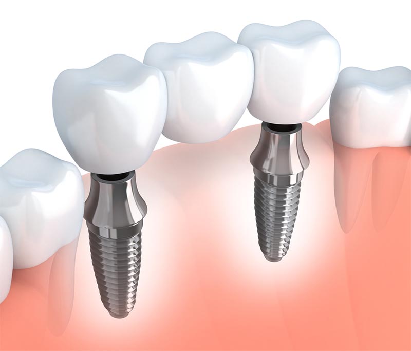 Puente dental sobre implante en valencia